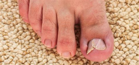 Toenail Problems - Ipswich Podiatry Centre