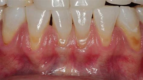 Emdogain - Sanclementeperiodontist