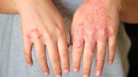 Red Spots On Skin: Here Are Its Common Causes And How To Get Rid Of ...