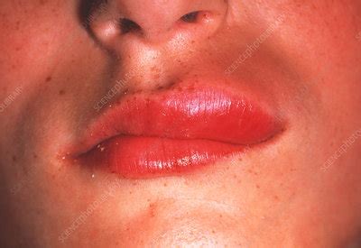 how to fix a swollen lip