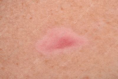 Bullous pemphigoid blister - Stock Image - C056/4403 - Science Photo ...