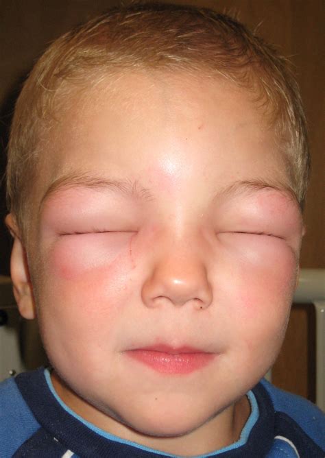 Angioedema / Body Swelling - Family Allergy