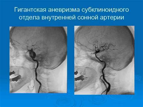 Артериальные аневризмы головного мозга Аневризмы — местное
