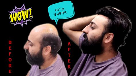 Hair Patch only 4599-rs #hairpatch #viral #hair #trending #viralvideo # ...