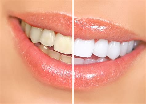 how to fix stained teeth