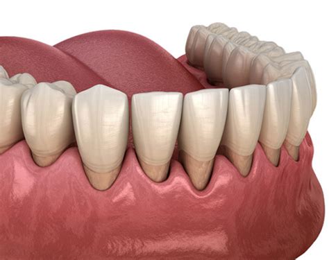 soft tissue treatments