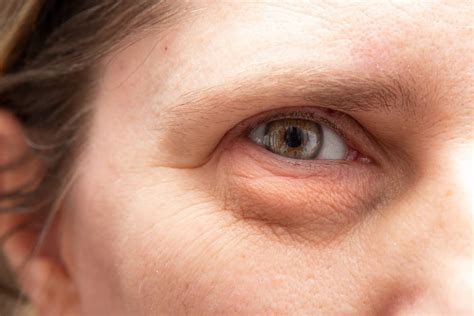 Bulging & Droopy Eyes: Causes & Treatments | Southwest Eyecare
