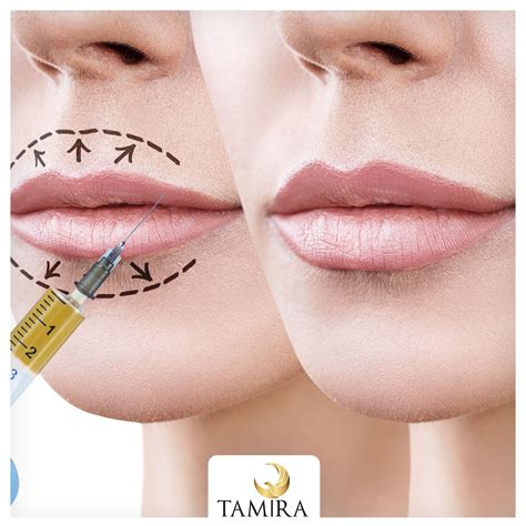 Lip fillers help enhance beauty when patients have a gummy smile. Tiny ...