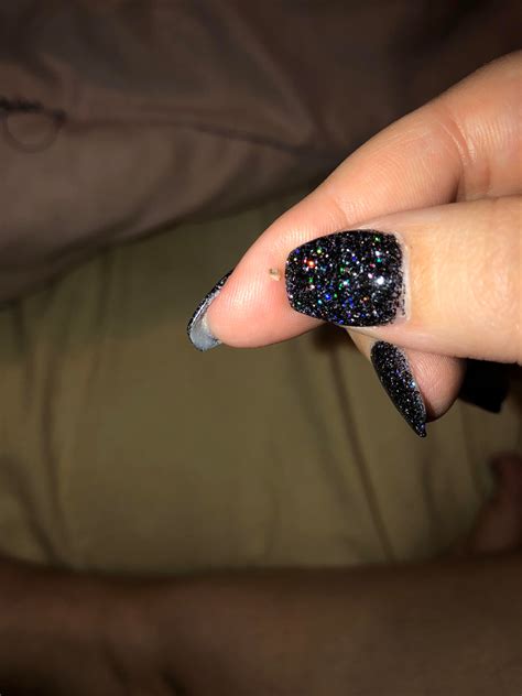 huge blackhead popping 2