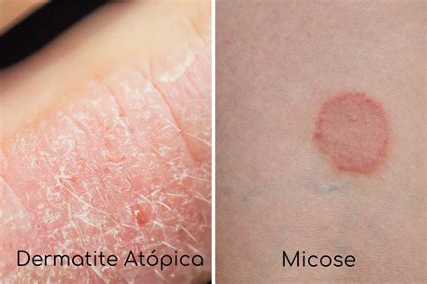Dermatite Atopica O Q É - Dermatite Atópica: O que é, sintomas, causas e tratamento | CliniGuia