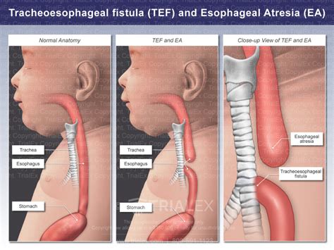 Esophageal Atresia Baby