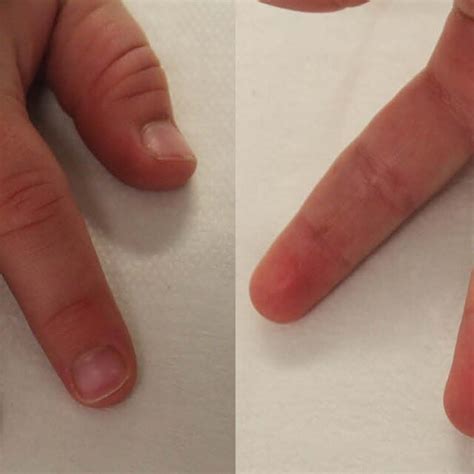 result  days  surgery note    digit nail