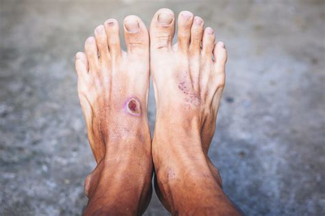 Diabetic Skin | DU'IT Skin Conditions