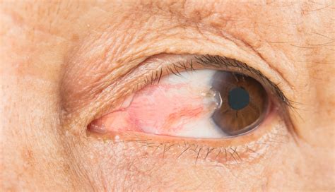 pterygium  treatments eduardo besser md