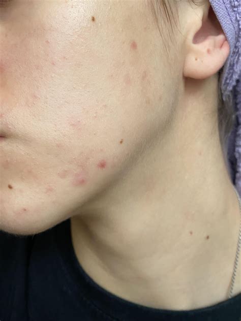 Celiac disease - effect on skin : r/SkincareAddicts
