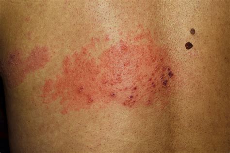 Stages of shingles | Virtuwell