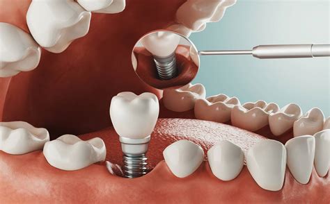 Types of Dental Implants | Including Cost & Benefits | Mint Dental SE1
