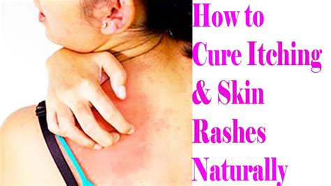 3 Most Effective And Easy Home Remedies For Itchy Skin | How to Cure ...