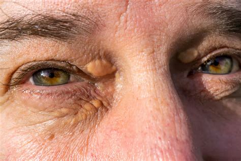 Xanthelasma: Understanding Causes, Symptoms &Treatments