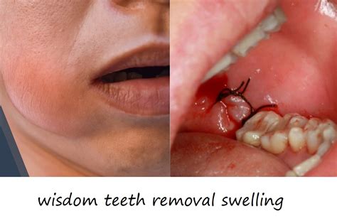 Wisdom Tooth Extraction Swelling Pericoronitis Wikipedia
