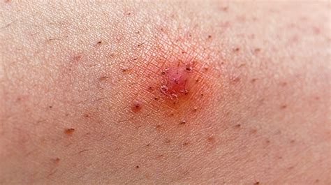Infected Ingrown Hair How To Treat Ingrown Hair | Greatist