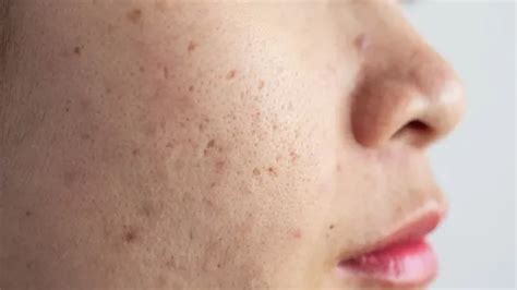 remove dark spots  scars naturally