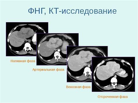 ФНГ печени: что такое фокальная нодулярная гиперплазия печени, симптомы ...