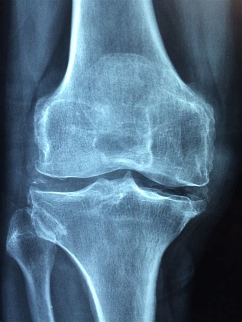 Patchy distribution of joint inflammation resolved
