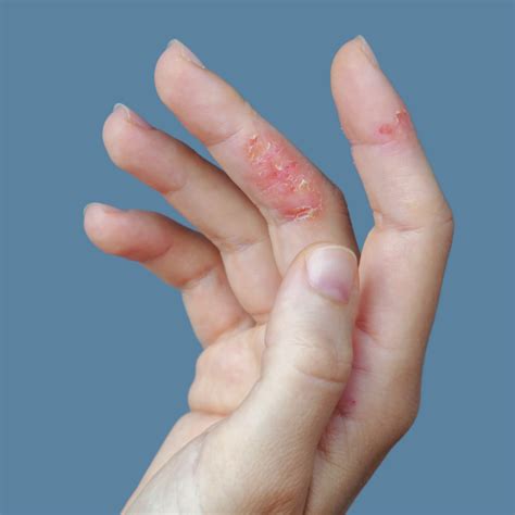 atopic hand dermatitis hand eczema symptoms  diagnosis