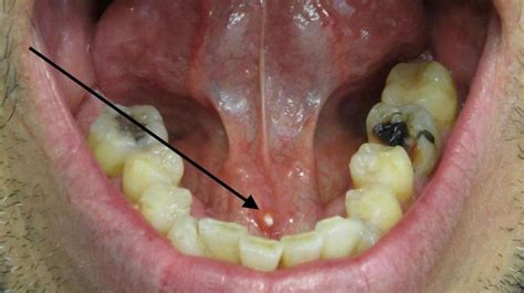 Lump On Floor Of Mouth Under Tongue - Popolando