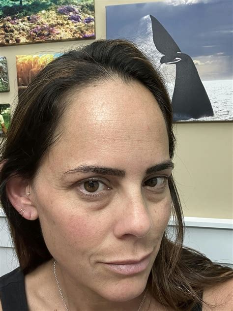 do frownies really work 6