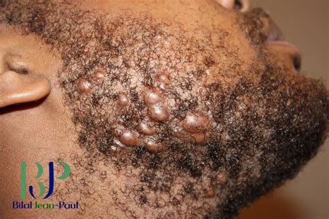 What Are Keloids| Bilal Jean-Paul | So It Begins with Bilal | What Are