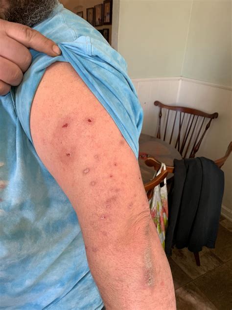 Spider Beetle Bites