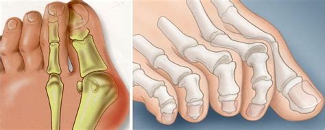 Захворювання стопи халлюкс вальгус (hallux valgus)