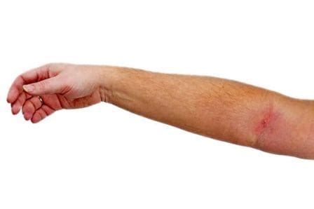 how to know if you have blood clot in arm