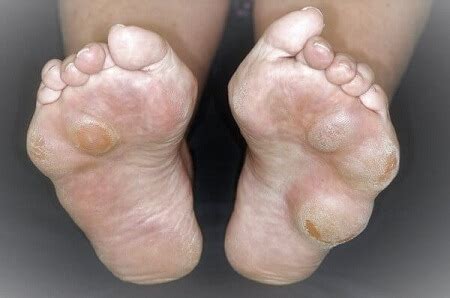lump  toes  bottom  foot store emergencydentistrycom