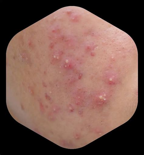 understanding acne cabtreo clindamycin phosphate adapalene