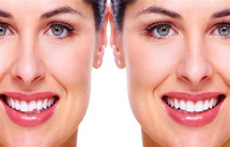 closer   teeth reshaping  contouring