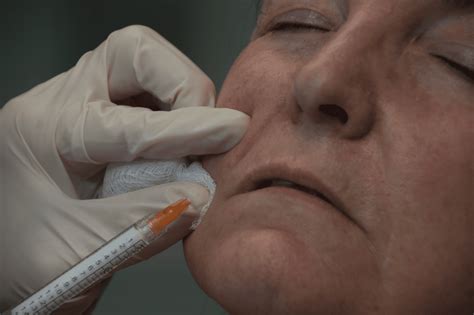 Radiesse - Aesthetic & Dermatology Center - Rockville, MD