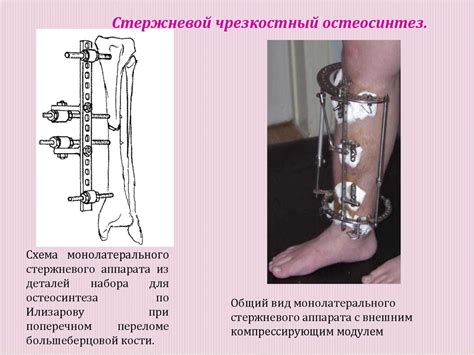 Основные принципы лечения переломов - презентация онлайн