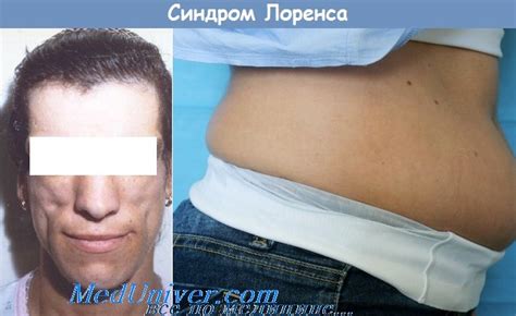 Синдром Лоренса (Lawrence) - синонимы, авторы, клиника