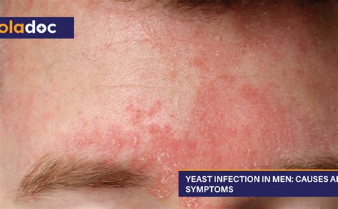 Yeast Infection Symptoms 733 Yeast Infection Symptom Images, Stock
