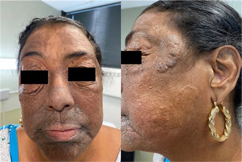 Plane xanthoma - JAAD Case Reports