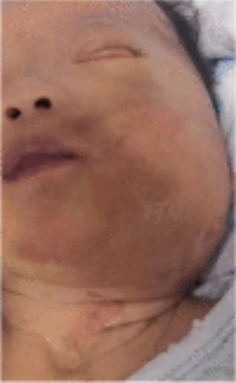Rare Disease