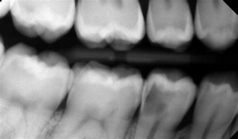 How Bioclear Challenges Age-Old Thinking About Treatment Of Caries ...