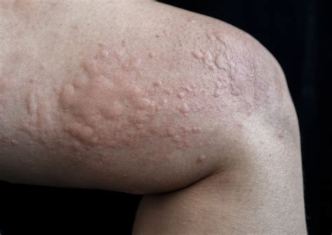 Hives Treatment In Singapore | By Dr Lee Hwee Chyen