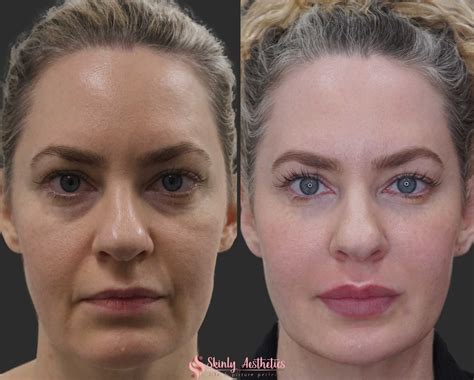 Unbelievable Blackhead Removal 2024: My Honest Review & Before/After Pics. Image 18