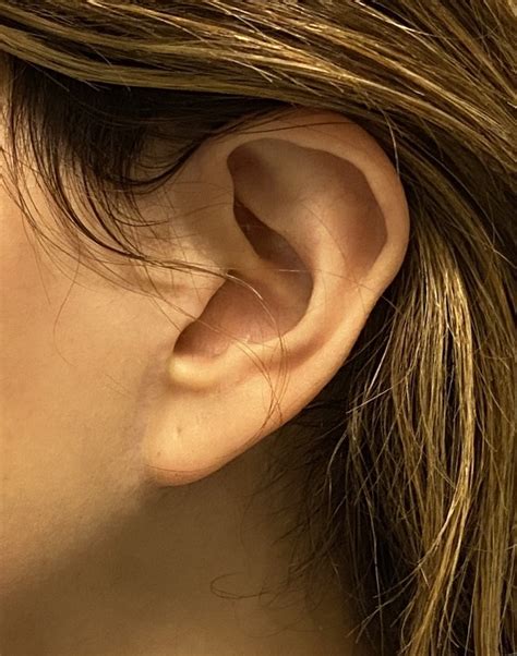 left pixie ear deformity  facelift dr barry eppley explore