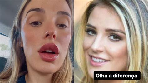 Rafa Brites Antes E Depois - Rafa Brites faz procedimento para dar volume aos lábios; compare ...