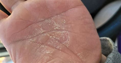 Why is my left palm itchy?